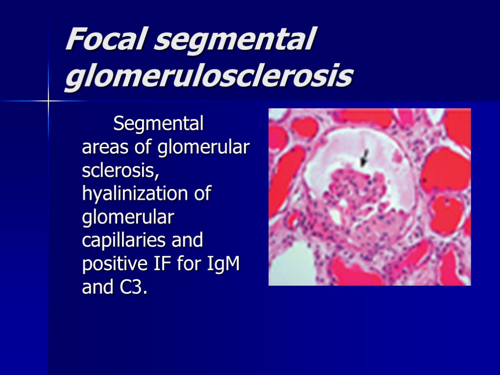 Focal segmental glomerulosclerosis Segmental areas of glomerular sclerosis, hyalinization of glomerular capillaries and positive